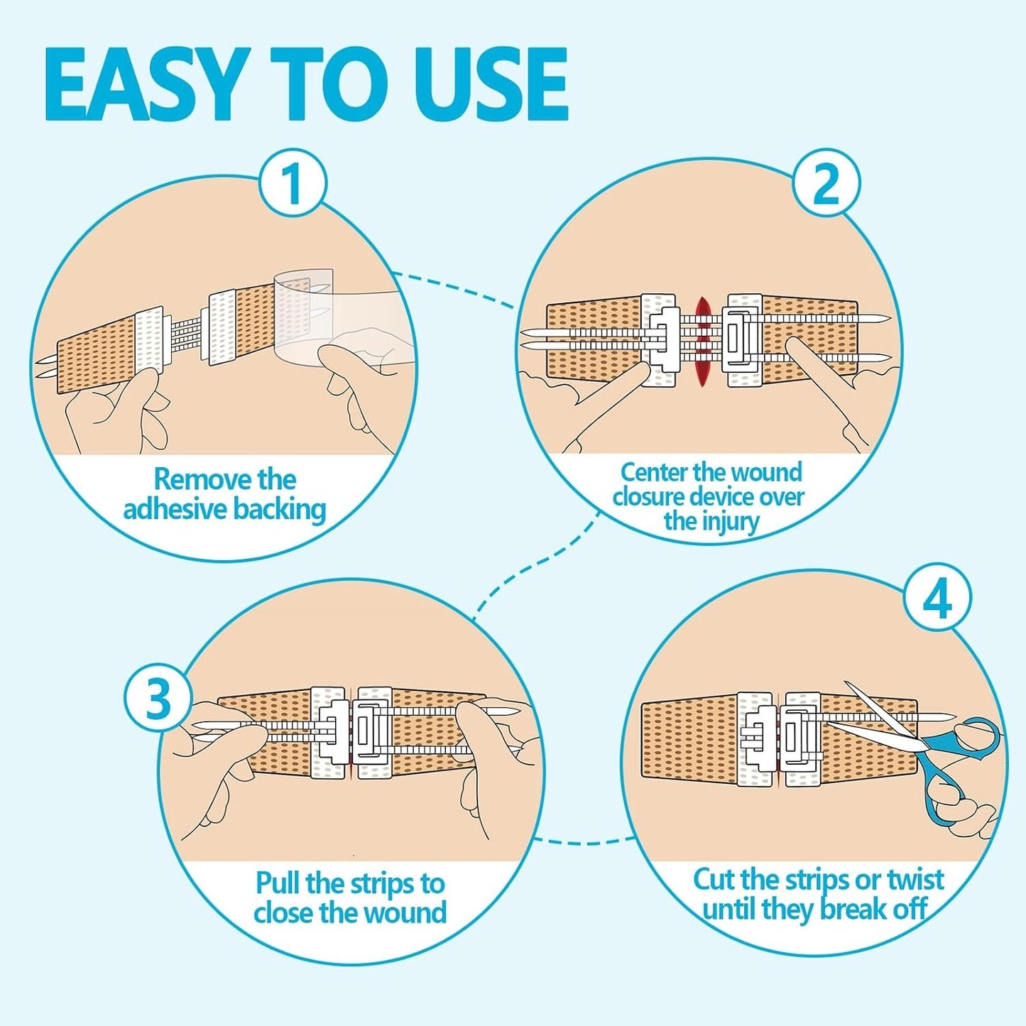 Wound Closure Device